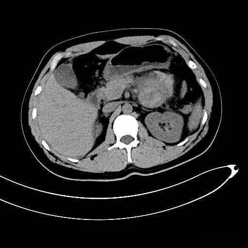 胰腺腺泡细胞癌