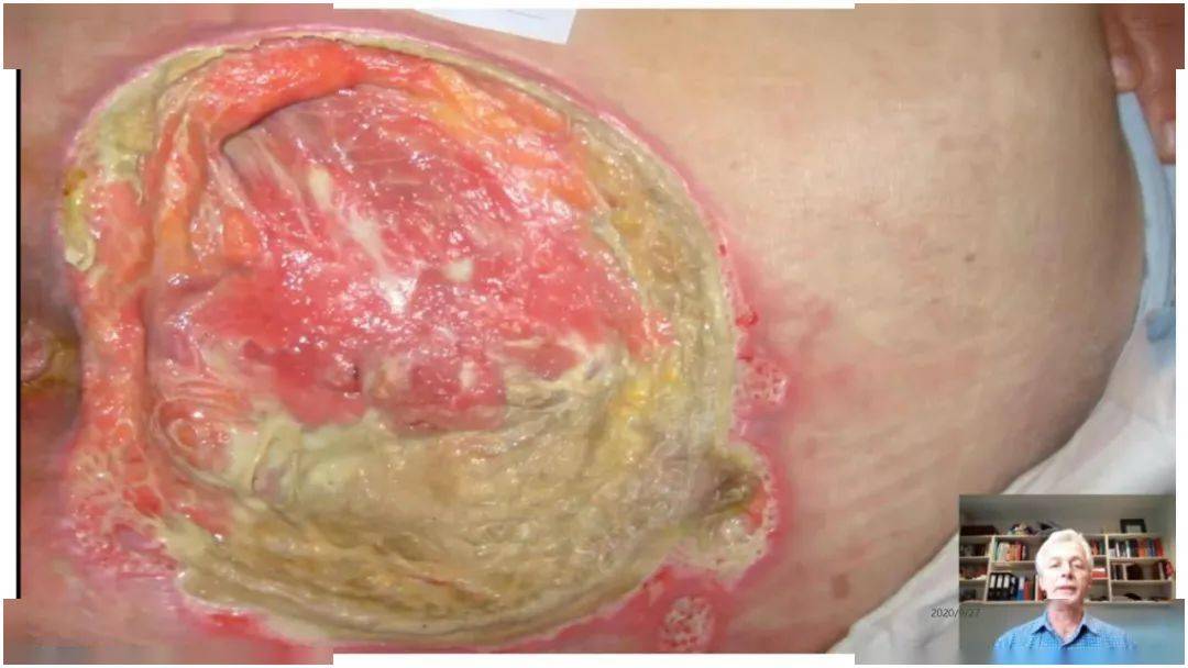 【ppt】2019国际压伤指南敷料应用的文献解读