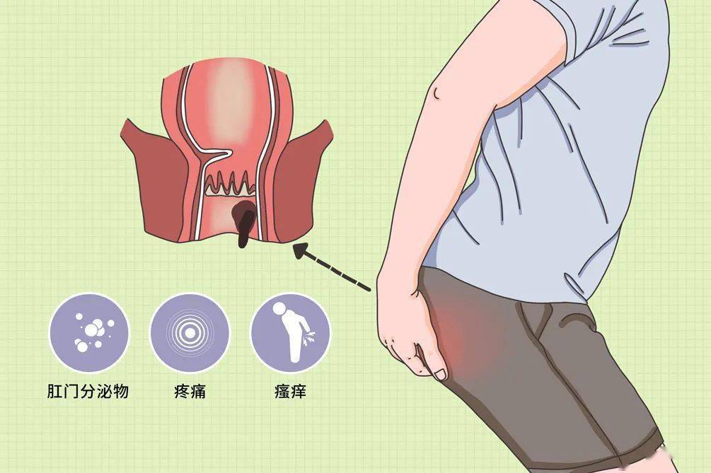 3分鐘教你辨別肛裂肛瘻痔瘡值得收藏