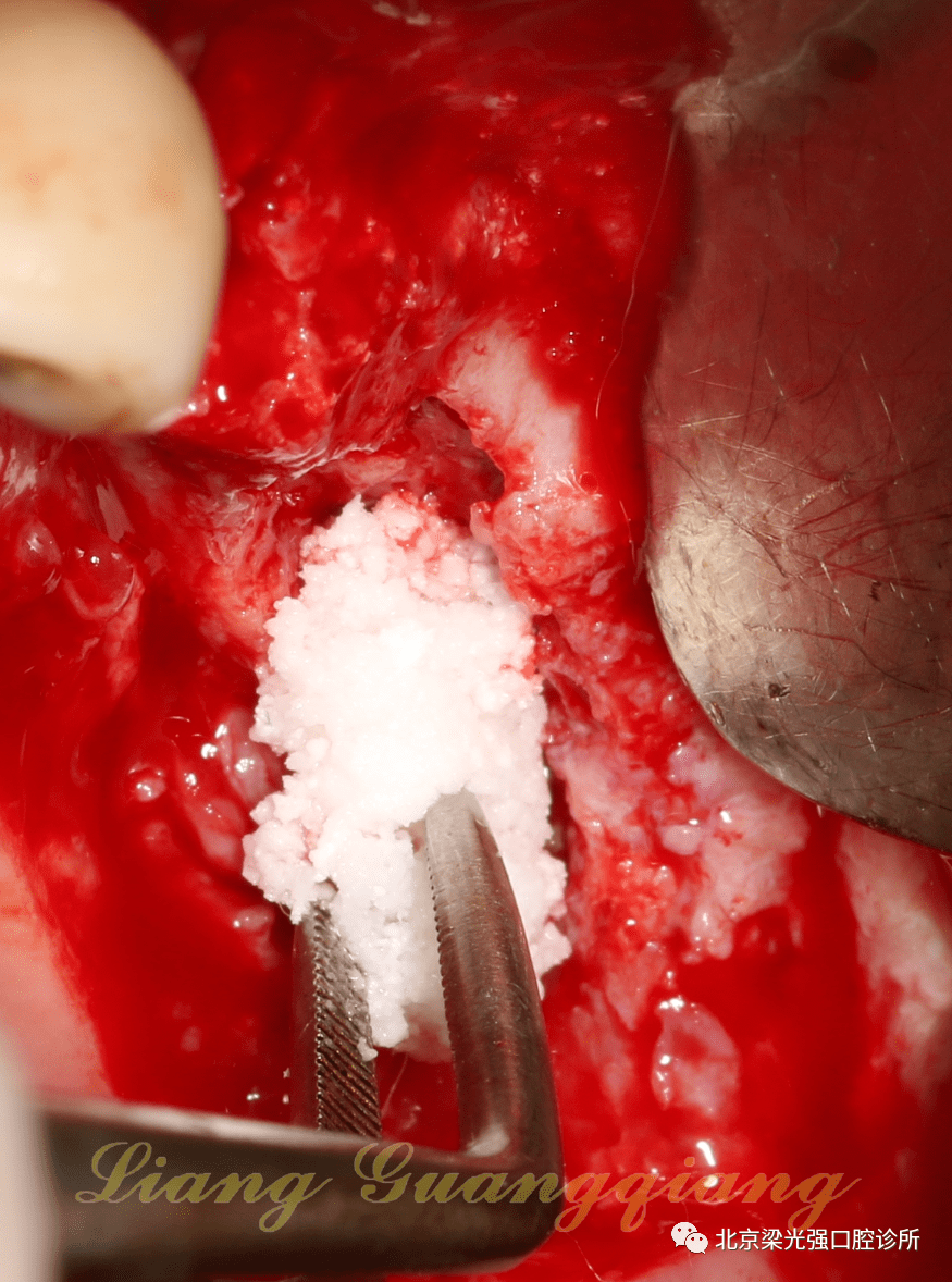 牙医学堂上颌窦膜破裂后二次种植