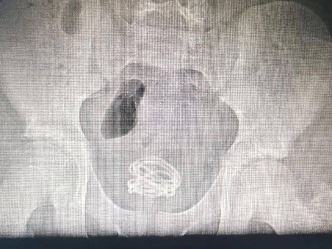 听着就疼13岁男孩把70厘米的电线塞进尿道里原因竟是