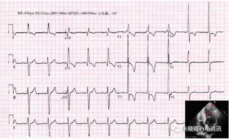 一文读懂常见心肌病的心电图表现