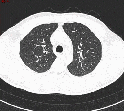 ct入门丨肺叶分段ct高清图谱