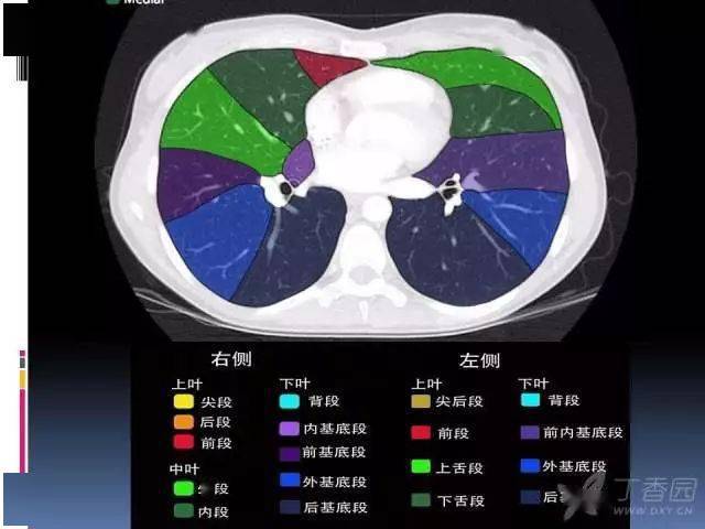 肺的分段分叶解剖图ct图片