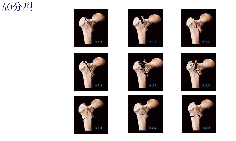 图解丨老年股骨粗隆间骨折治疗的方式与选择