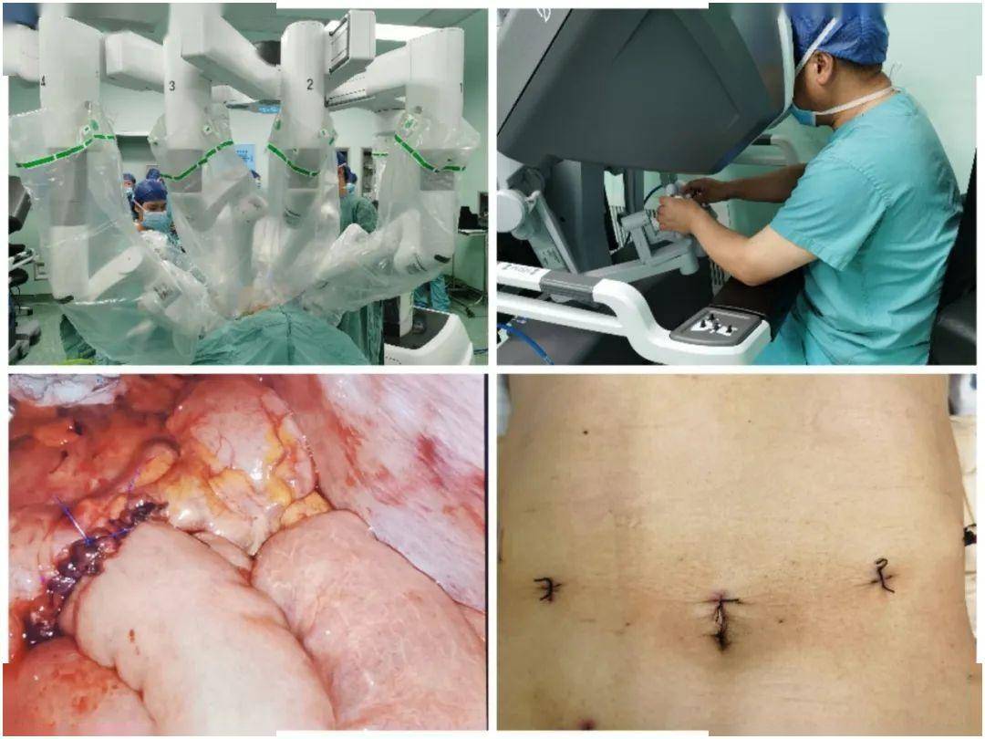 湖南省人民医院成功开展达芬奇机器人辅助手术