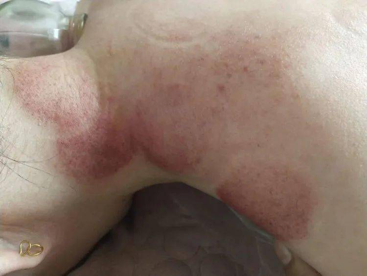 199元抢颈侧淋巴排毒肩颈拔罐让你从头爽到脚