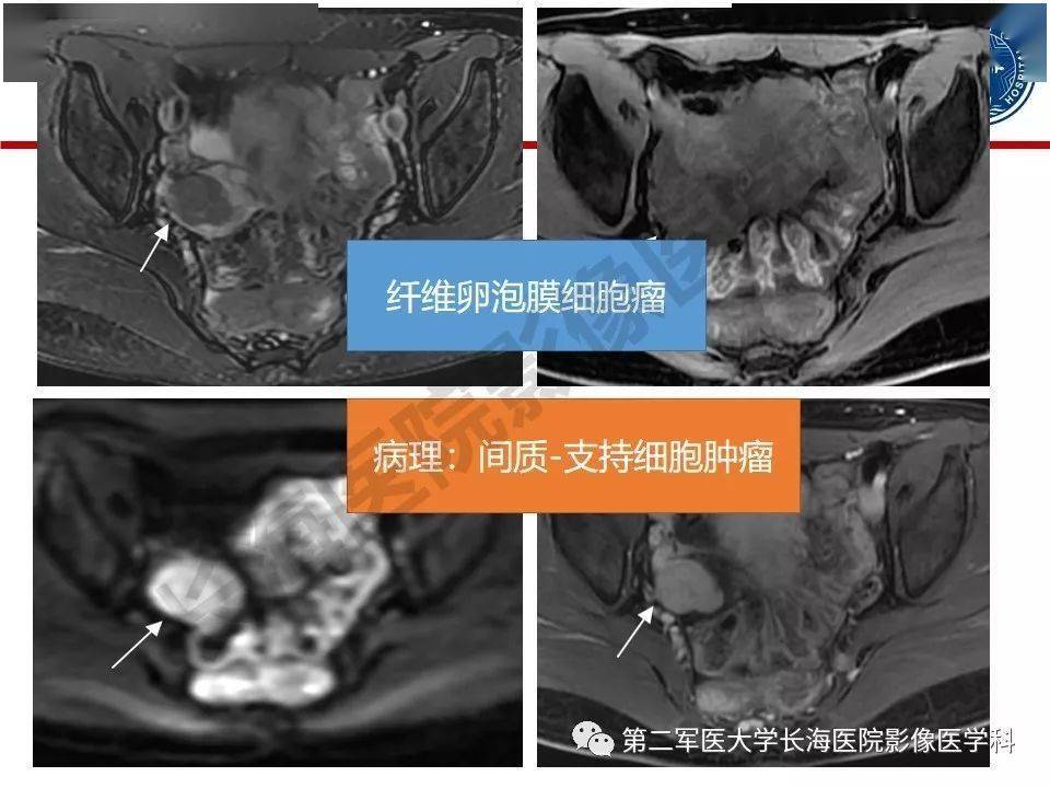 纤维卵泡膜细胞肿瘤影像诊断