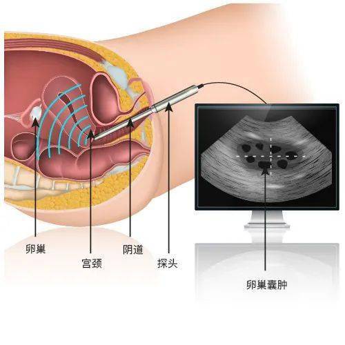 【宫颈纳氏囊肿】:生理性的宫颈小囊肿,只要定期进行宫颈癌筛查,不