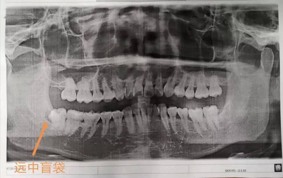 口腔科臨床上經常有拔除下頜智齒幾年後,上頜智齒慢慢出現伸長的現象