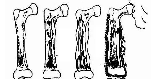 骨髓炎一个让你苦不堪言也能治疗的炎症