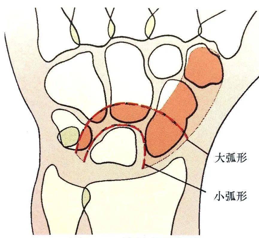 腕关节最常见的脱位是舟骨月骨脱位,月骨周围脱位