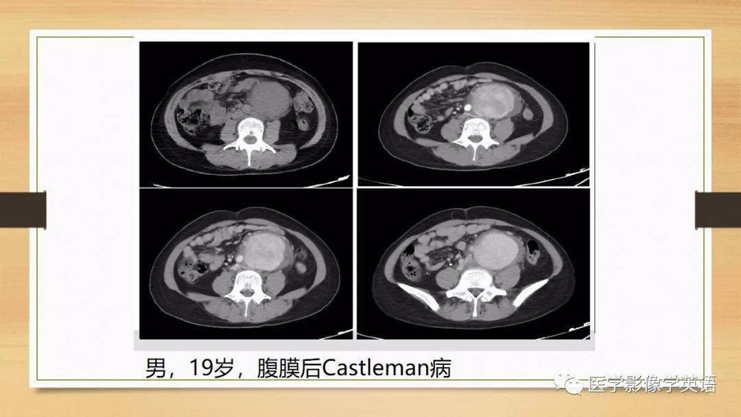 常見原發性腹膜後腫瘤影像診斷及鑑別診斷