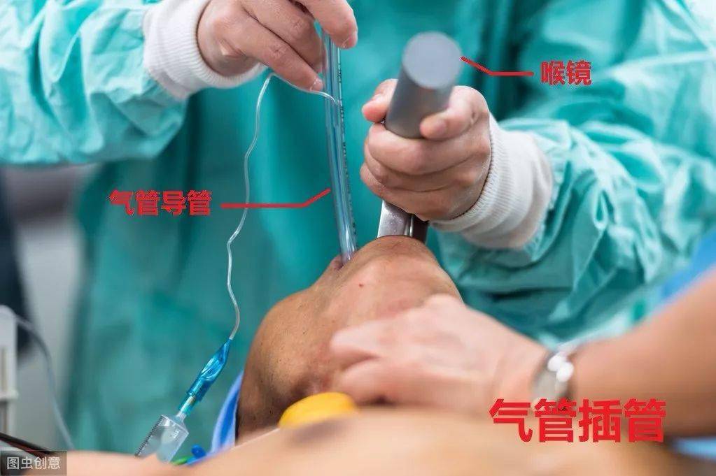 (这是气管插管的装备:喉镜&导管)人体和呼吸机是分开的,呼吸机要怎么