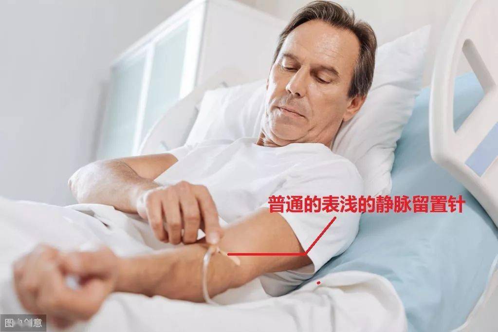 普通住院病人静脉输液时,都是打一个简单静脉留置针就可以了,在手背