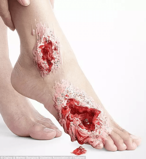 型糖尿病的并发症恰恰相似,二型糖尿病伤口会出现难以愈合,溃疡,坏疽