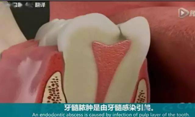 脓水没有地方发泄 ↓ 脓水穿透骨头冲到牙床 ↓ 肿胀 ↓ 肉眼见到牙龈