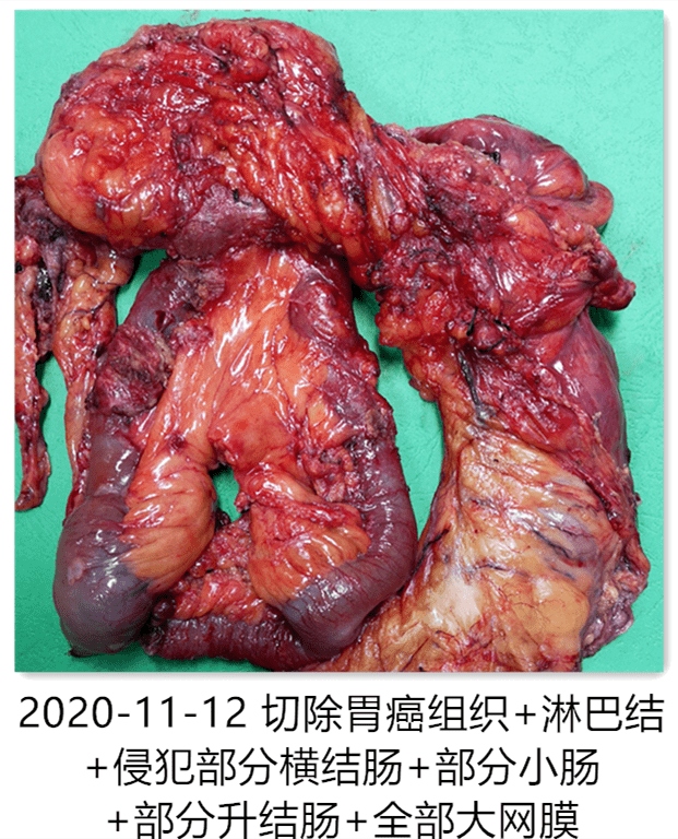 四期腹膜转移胃癌患者还有手术机会吗外科专家这样说