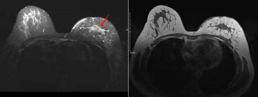 庐江女性福音 县医院开展乳腺mri