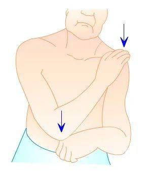 (dugas sign)又称"肩内收试验","搭肩试验","杜加斯试验".