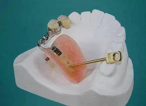 活动假牙 来自搜狐网