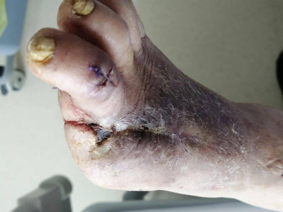 聚焦临床我院骨科开展多种技术联合治疗重度糖尿病足