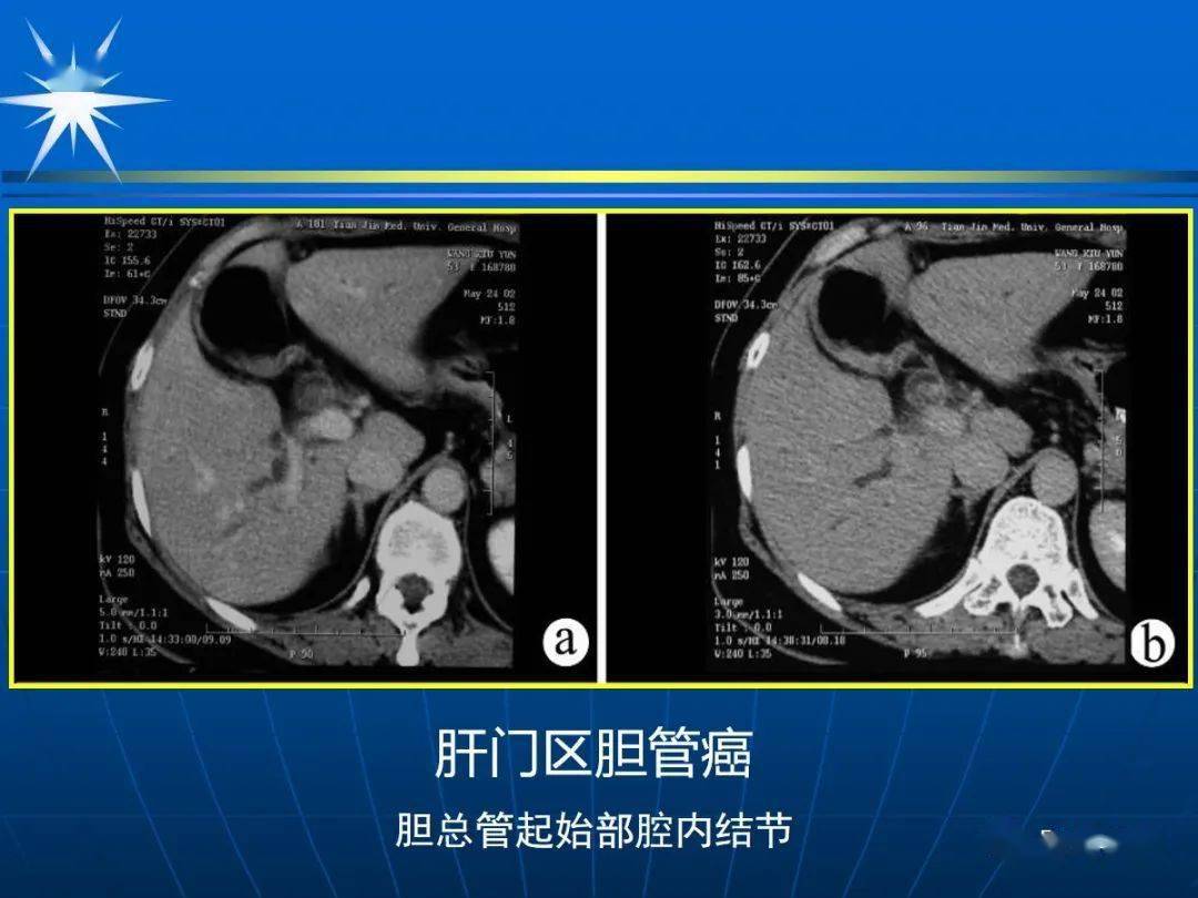 7種膽道系統疾病影像診斷