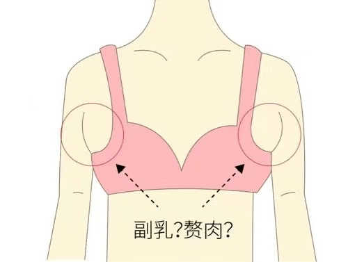 產後副乳多一坨贅肉影響的只是美觀不危害可多