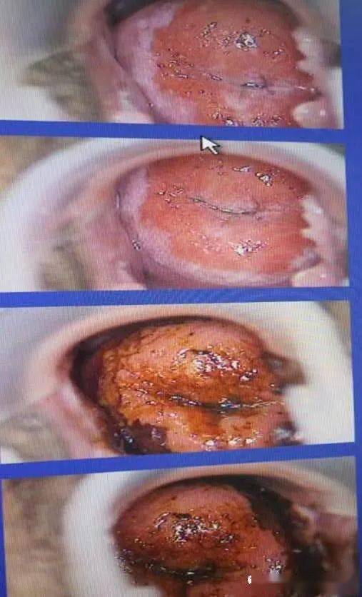 宫颈癌早期黄水 初期图片