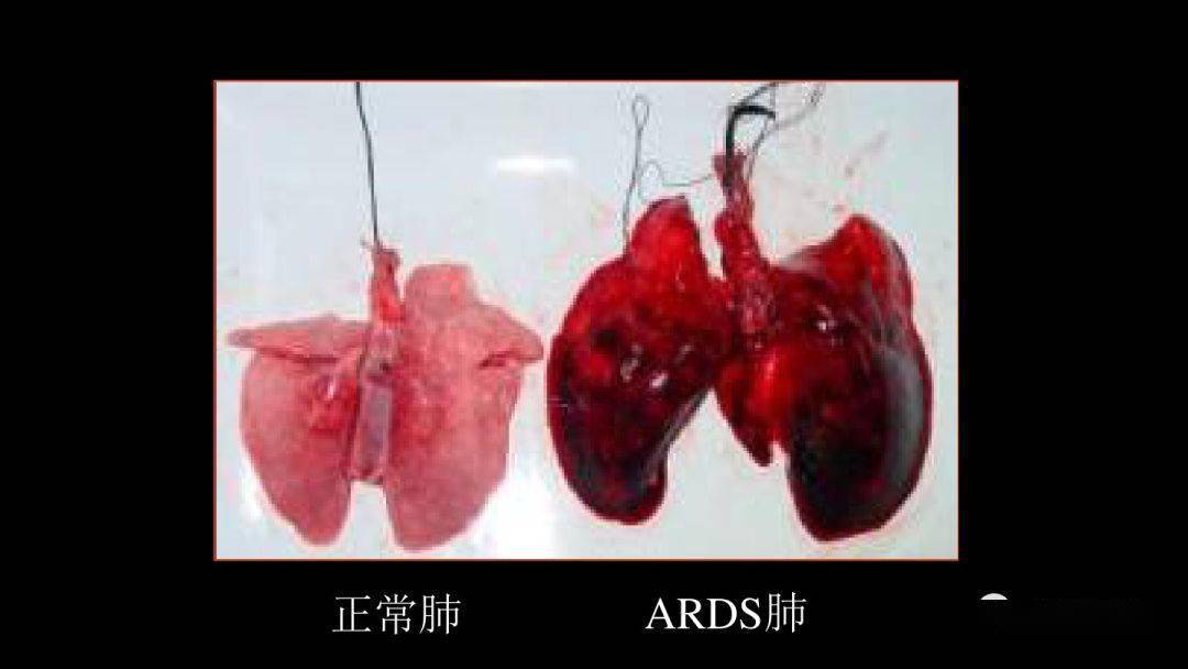 急性呼吸窘迫综合征(ards)的影像学表现