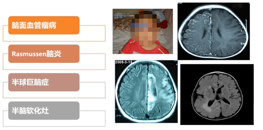 脑医咨询-名家科普 ▏第五期:难治性癫痫外科治疗的目标:治愈癫痫!_检