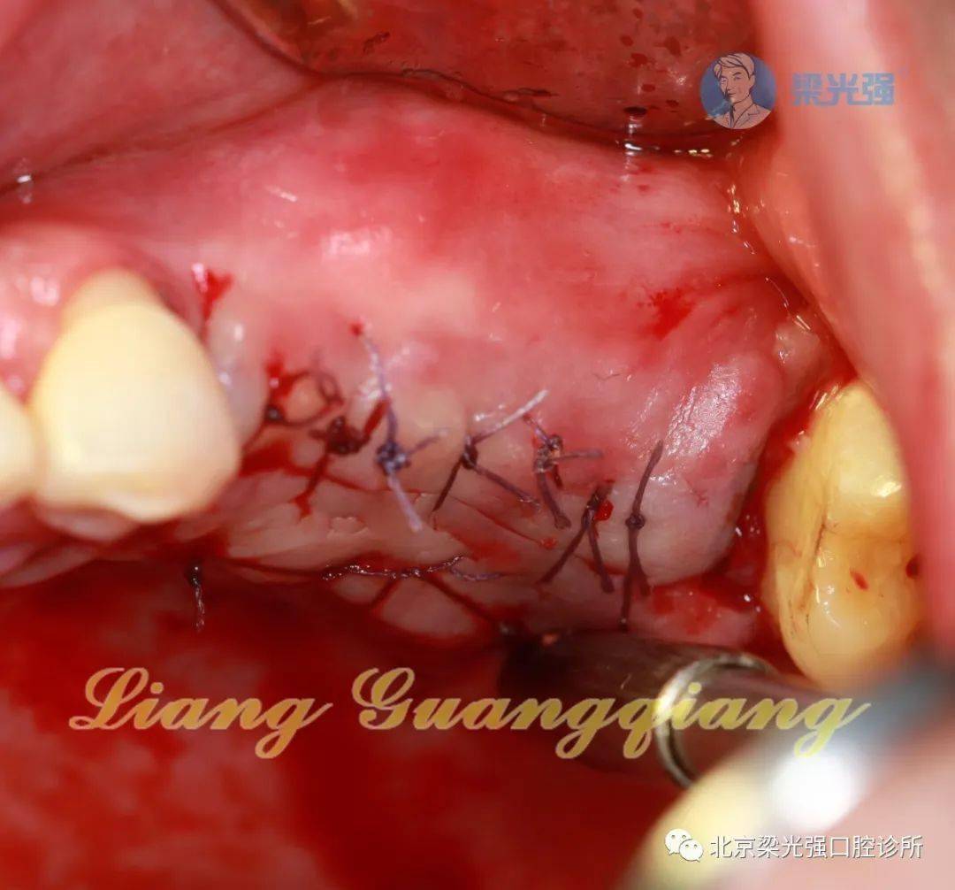 手术最终也顺利结束,术中敲击内提做完之后,做鼓鼻实验,验证完全没有