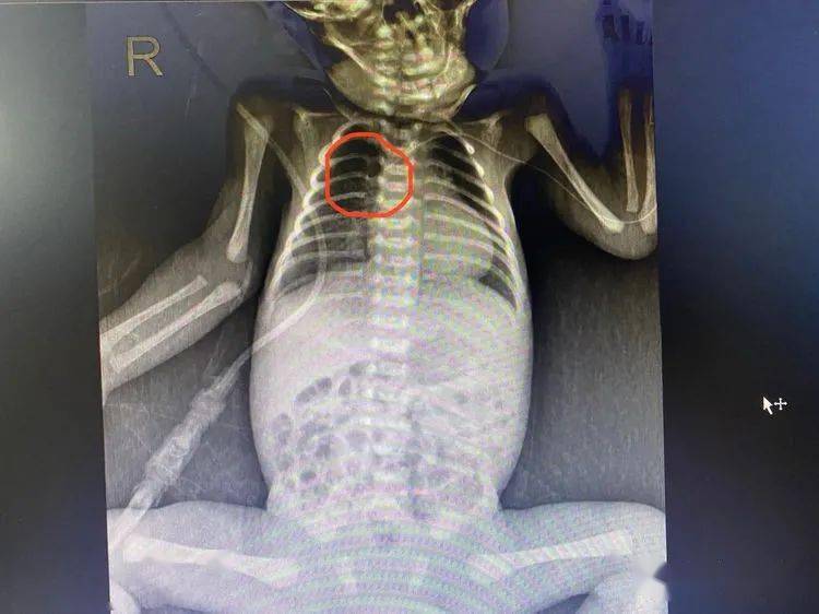 胸部x线进行picc导管定位,导管头端位于上腔静脉中下段截止发稿时picc