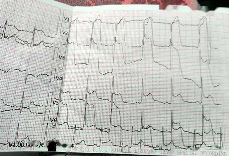 唐昌二医院*心电图先发过来看一下区人民医院—龚厚文刚接诊一位