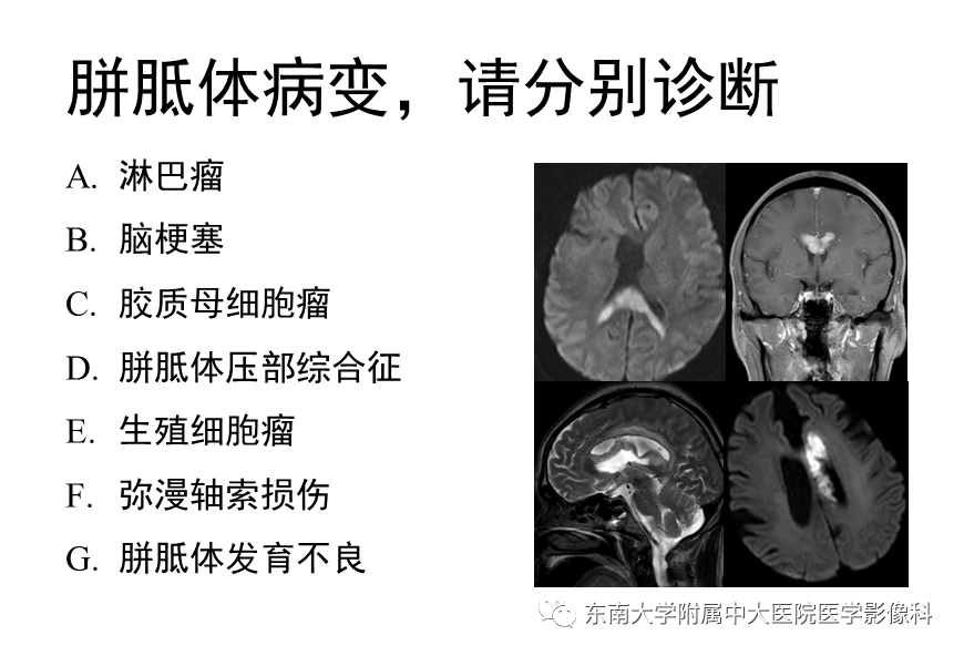 易激惹,实验室检查无异常 编辑/校对:时文伟 病例结果 可逆性 胼胝体