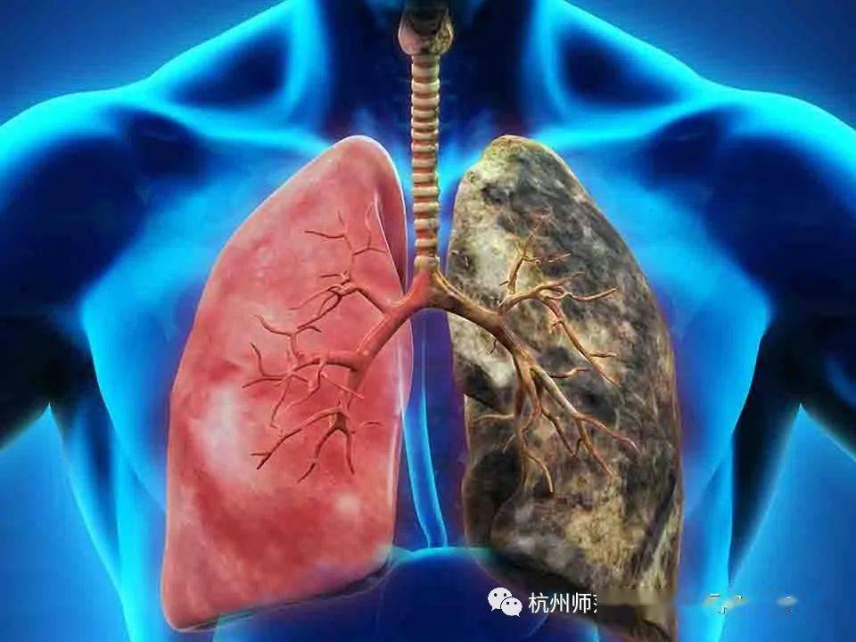 慢性阻塞性肺病(copd)是一种具有气流阻塞特征的肺部疾病.