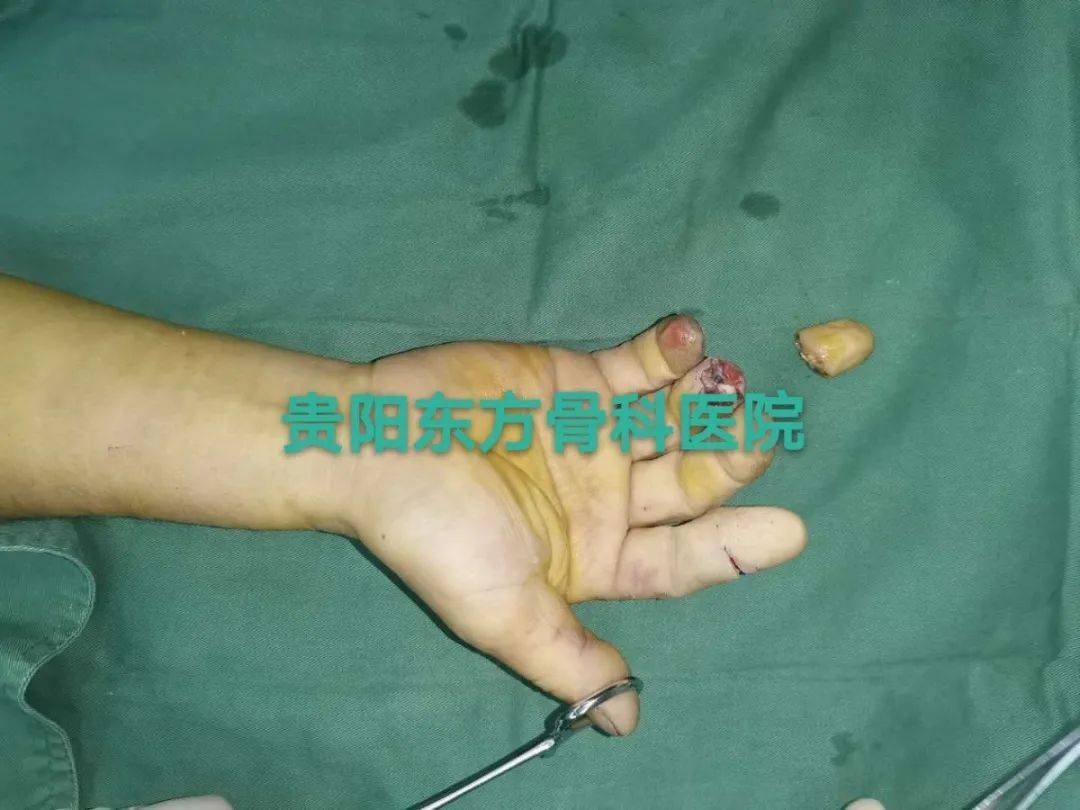 吉先生右环指远节完全断离并远指间关节缺损伤,右示,中指不同程度离断