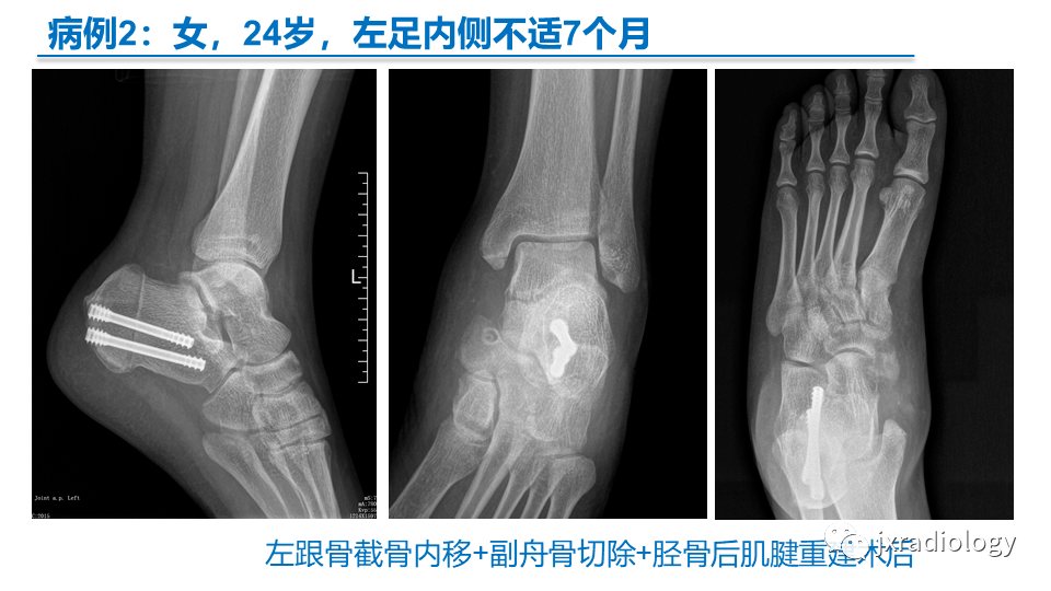 足副舟骨分型及相关病变的影像表现