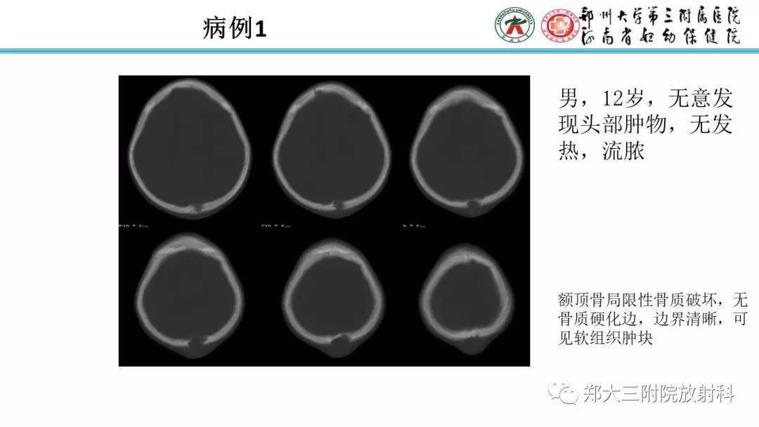 颅骨嗜酸性肉芽肿图片