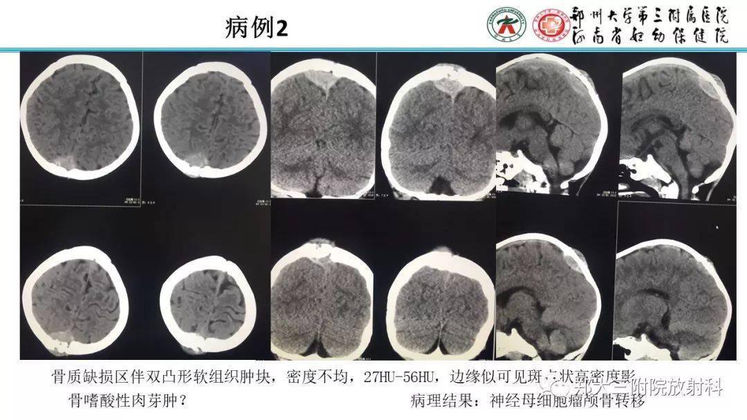 颅骨嗜酸性肉芽肿图片