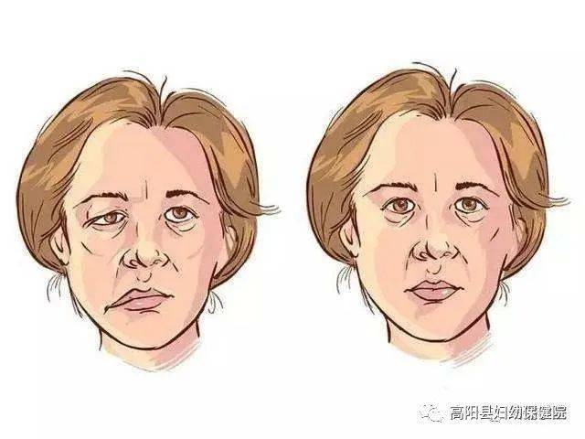 俗称"吊线风","歪歪嘴","小中风"等,不是什么大病,但嘴歪口斜,严重