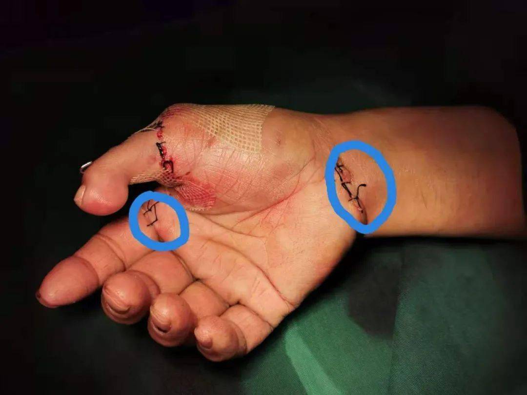 (术后六周,准备取除内固定克氏针时视频)目前,患者右手功能良好,基本