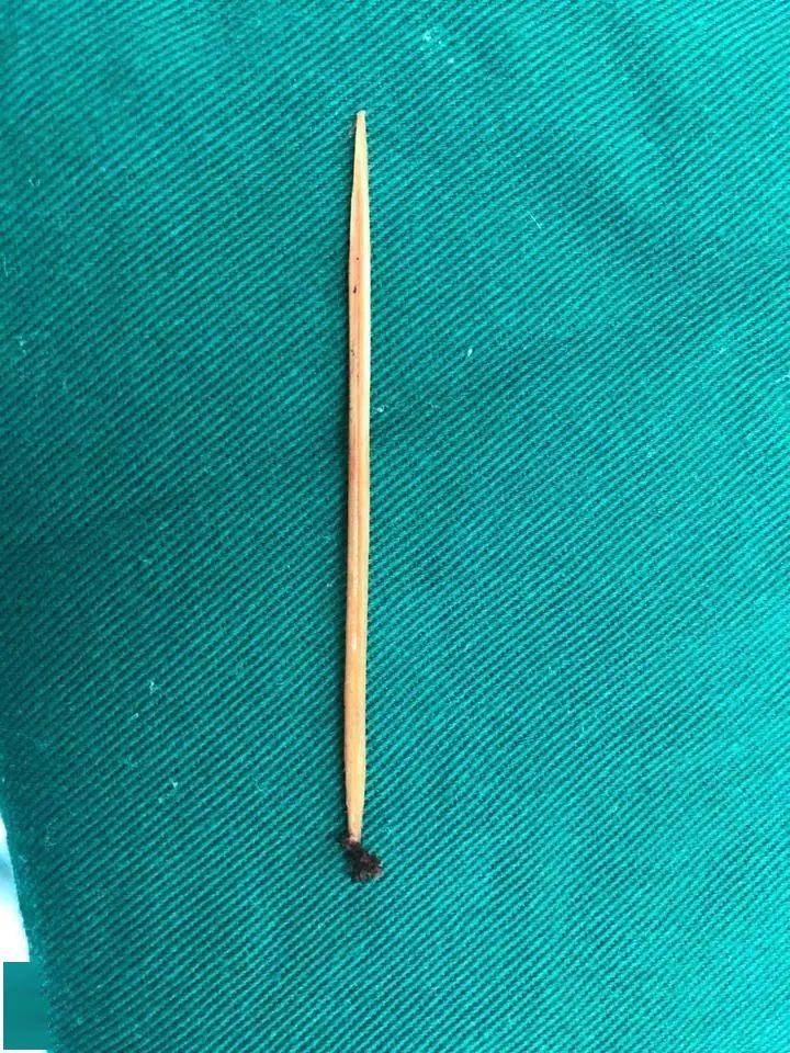 衢州11岁男孩,肝脏插进一整根牙签!医生一查原因惊呆_手机搜狐网