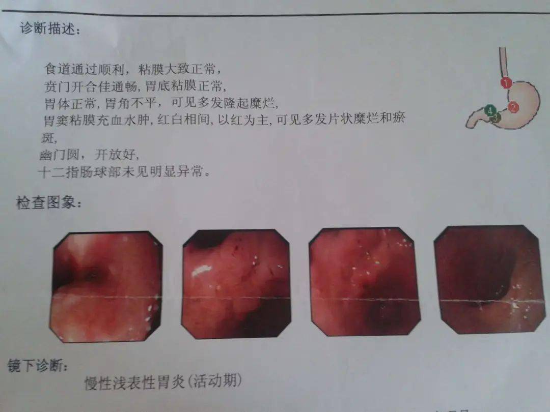 慢性肠炎有什么症状图片