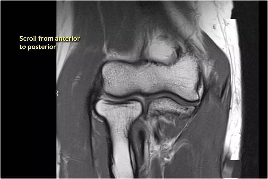 肘关节横断解剖图CT图片