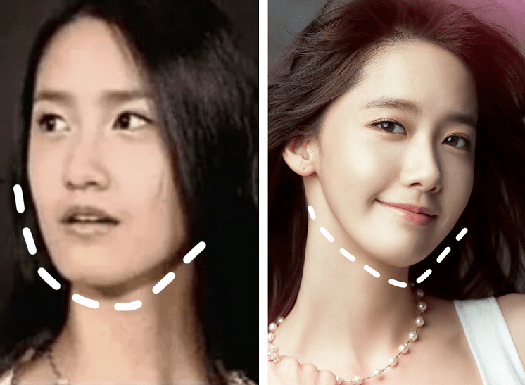 削下颌角再加上正颌两个动骨大手术,让u型脸成功变为v型.