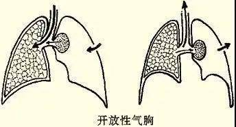 我的肺气炸了气胸