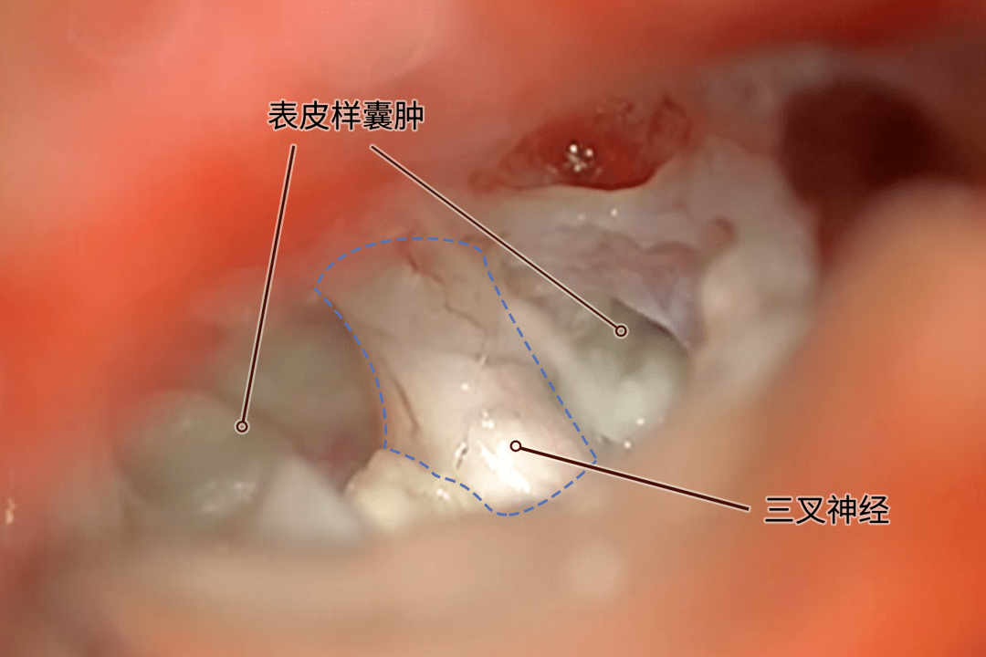 經常不規律臉痛耳朵痛竟是因為腦子裡長了瘤