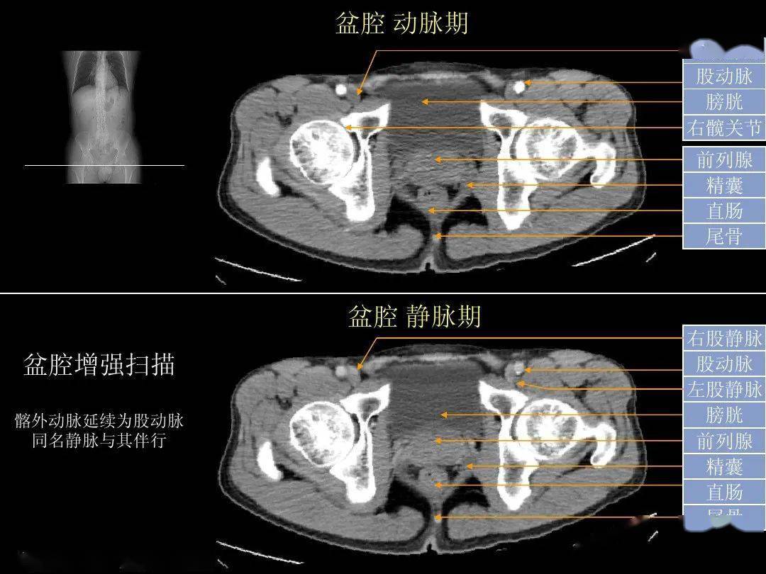 髂腰肌ct解剖图图片