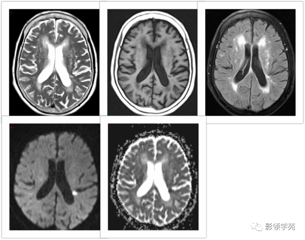 脑小血管病的影像学诊断